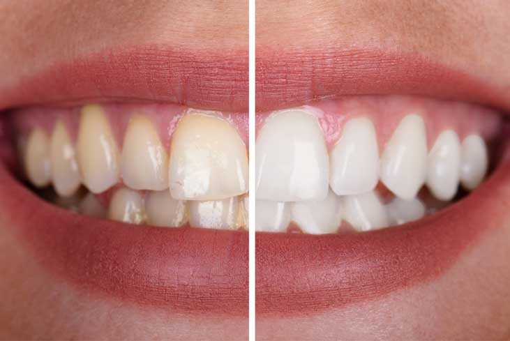 | GYA Dental Center | Апрель, 2025 | GYA Dental Center | Апрель, 2025