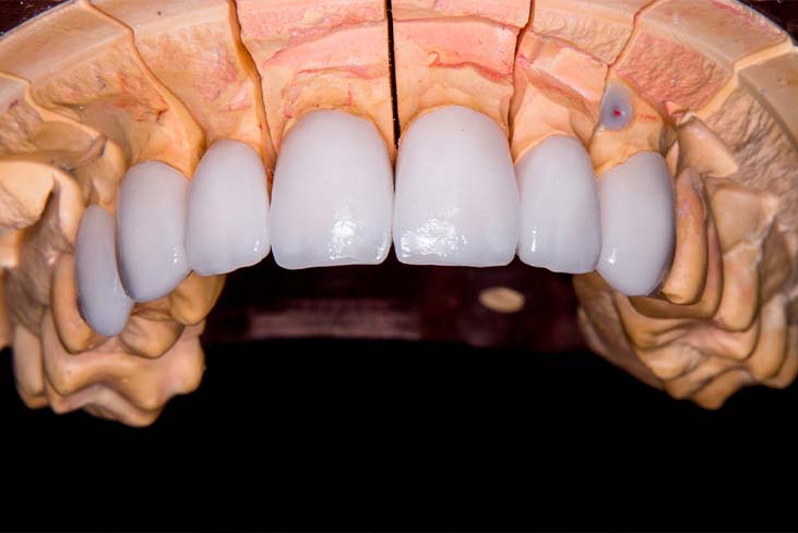 So,-What-Are-Dental-Veneers So, What are Dental Veneers