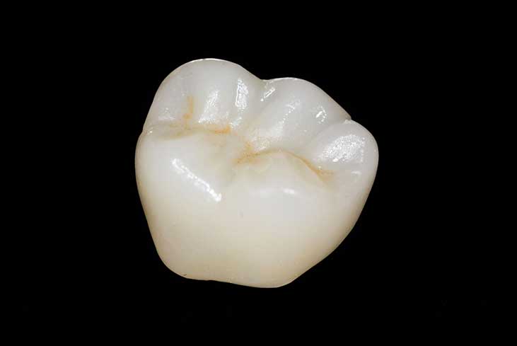 Porcelain Crowns Porcelain crowns
