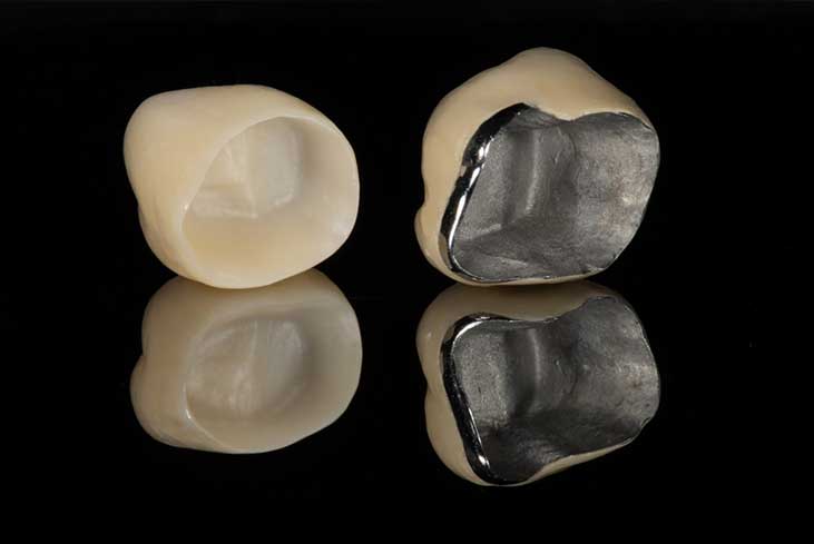 Porcelain Fused To Metal Crowns Porcelain fused to metal crowns
