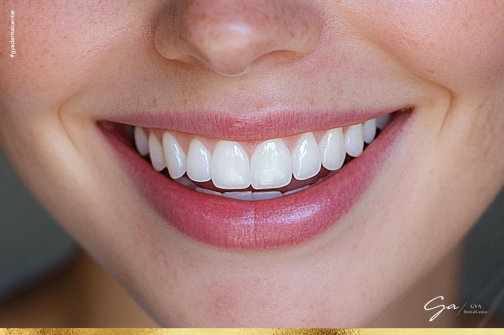 كومبوزيت فينير إجراءات طب الأسنان التجميلية