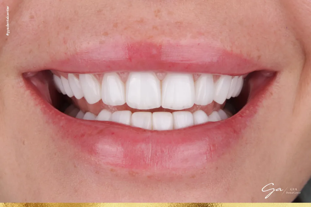 فينير الأسنان إجراءات طب الأسنان التجميلية
