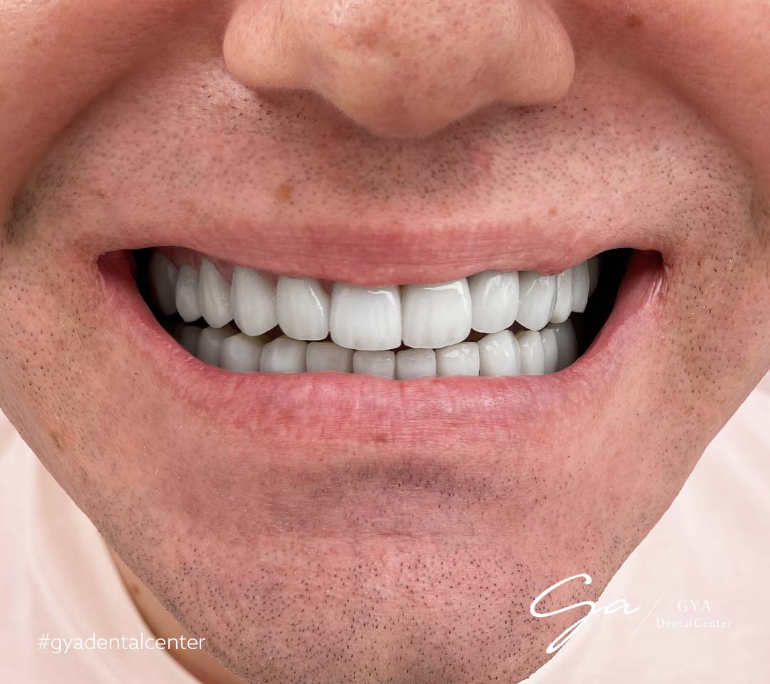 | GYA Dental Center | Апрель, 2025 | GYA Dental Center | Апрель, 2025