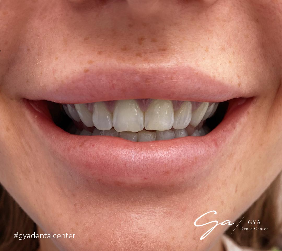 | GYA Dental Center | Апрель, 2025 | GYA Dental Center | Апрель, 2025