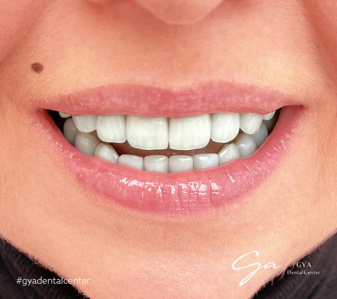 Виниры доктора Габриэллы | GYA Dental Center | Апрель, 2025
