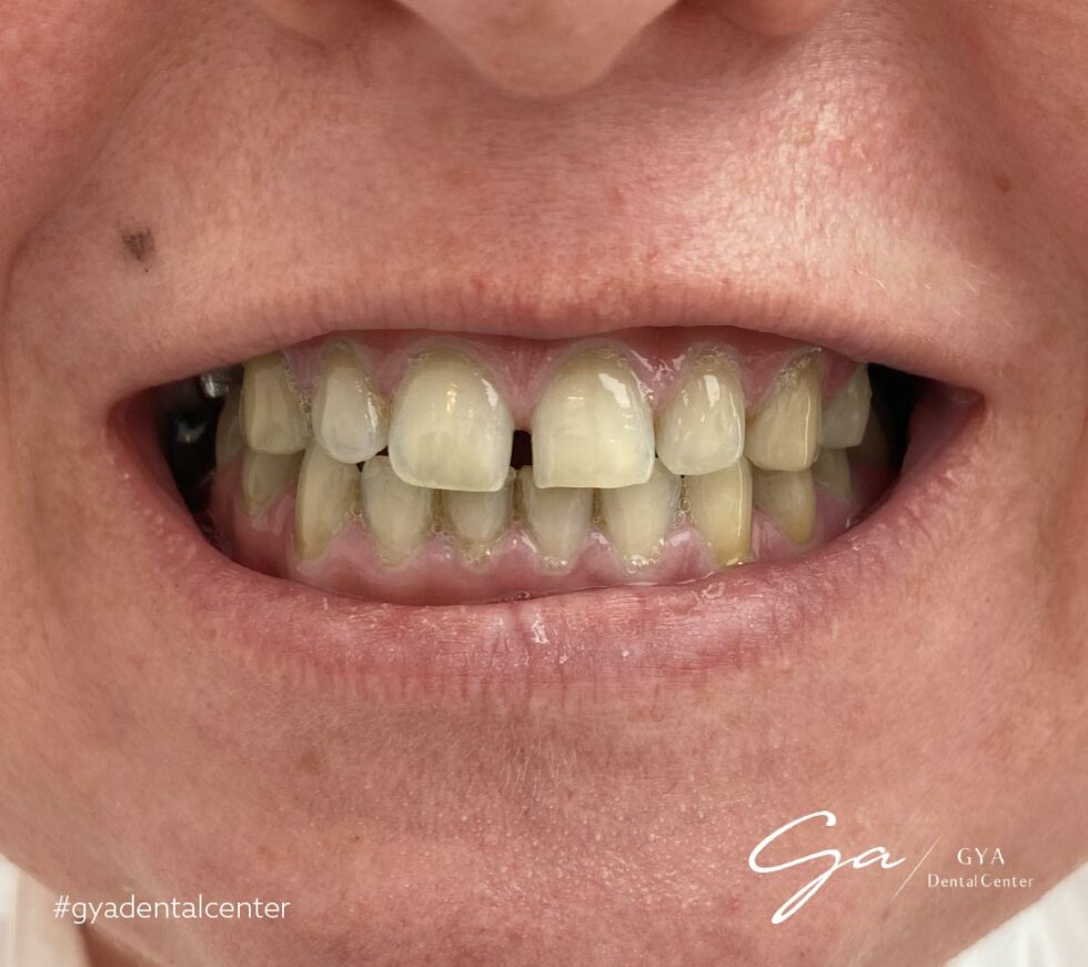 Best Dental Veneers in Dubai (2024) GYA Dental Center