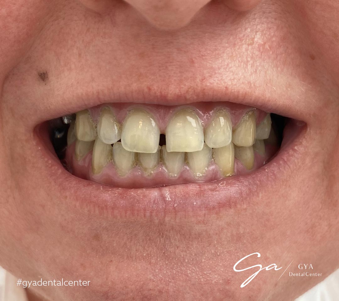 | GYA Dental Center | Апрель, 2025 | GYA Dental Center | Апрель, 2025