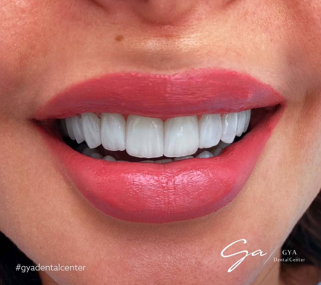 Виниры доктора Габриэллы | GYA Dental Center | Апрель, 2025