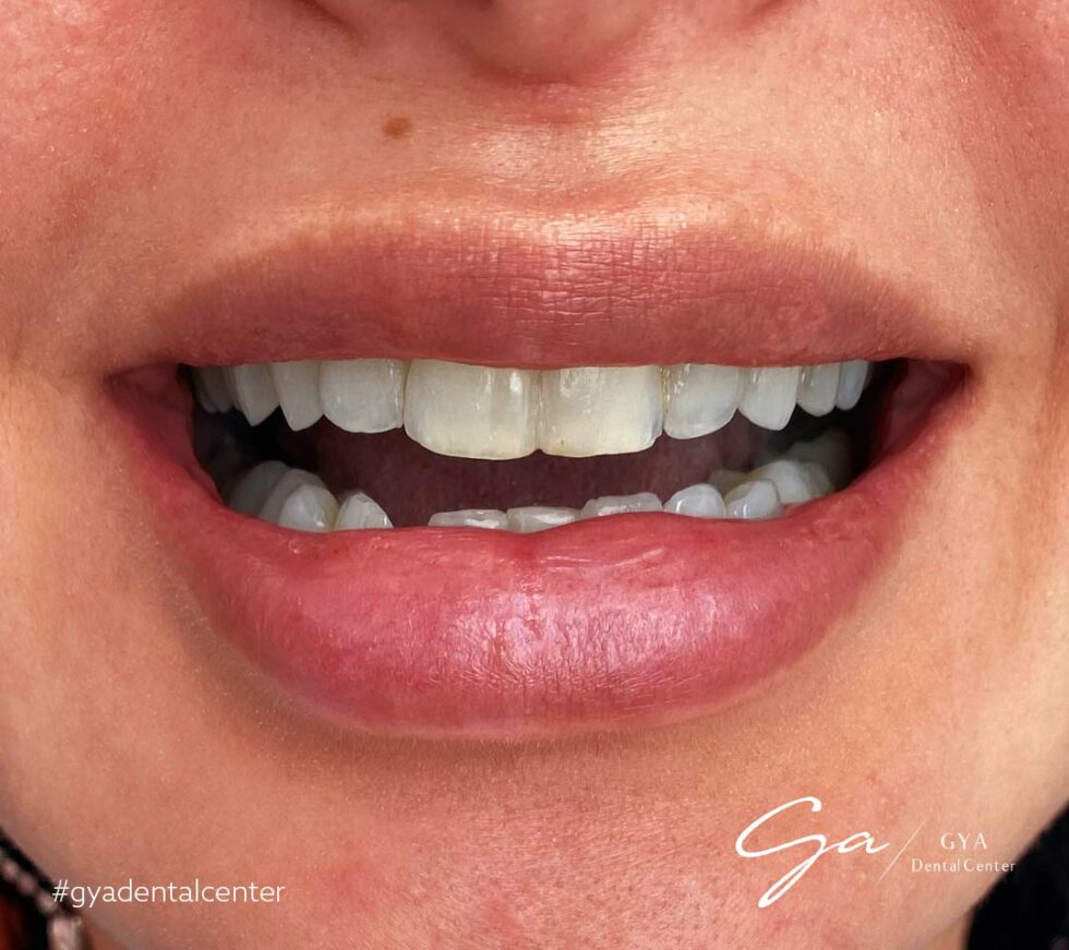 Best Dental Veneers in Dubai (2024) GYA Dental Center