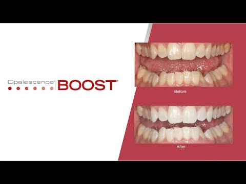 Opalescence Teeth Whitening Gel Before and after