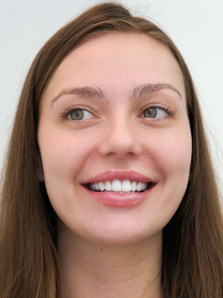 Dental Veneers in Dubai After Front Smile Makeover GYA Dental Center