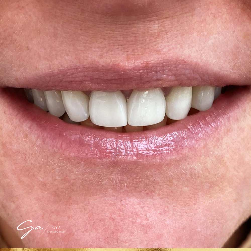 | GYA Dental Center | April, 2025 Composite-Veneers_Best Types Of Dental Veneers In Dubai