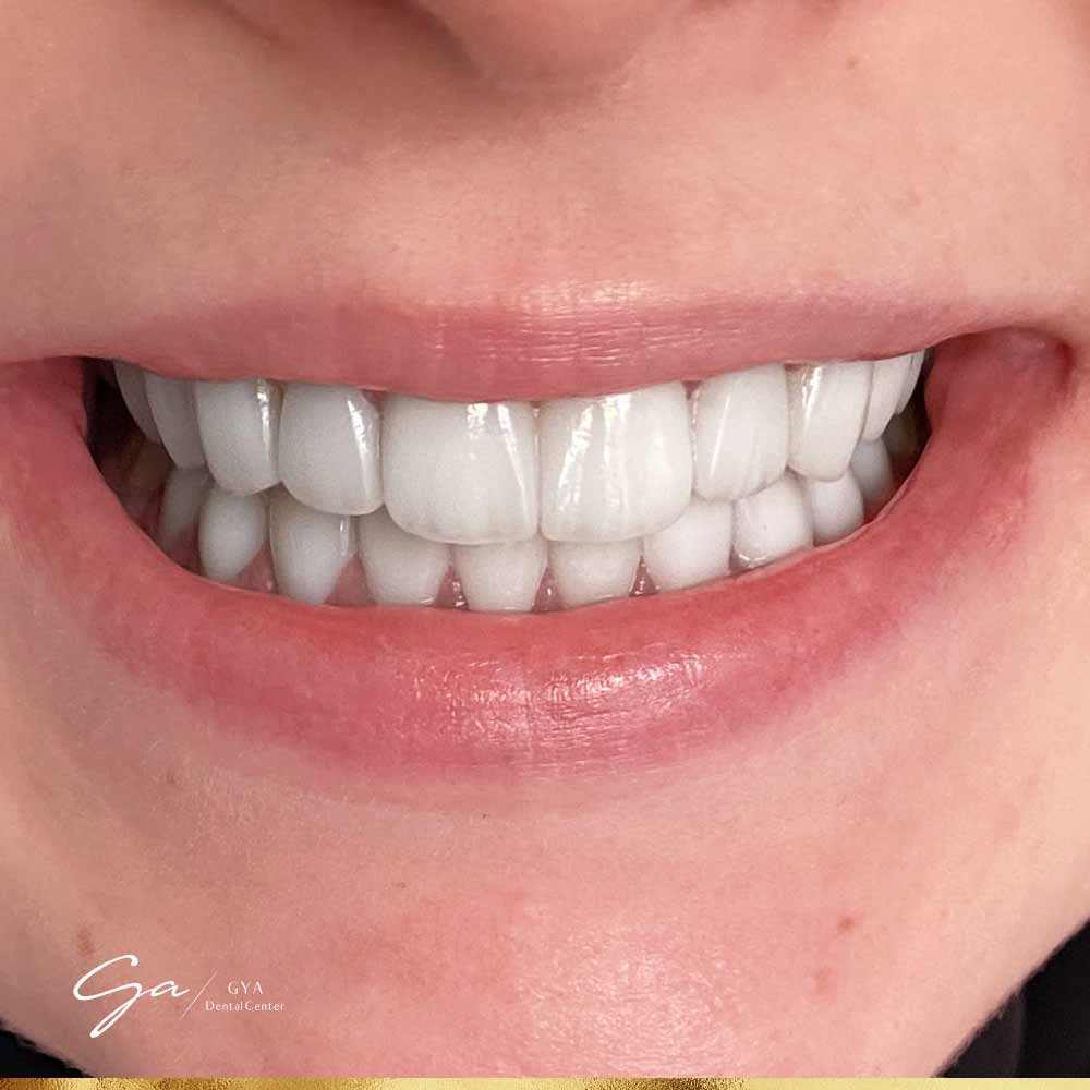 | GYA Dental Center | April, 2025 Emax Veneers__Best Types Of Dental Veneers In Dubai