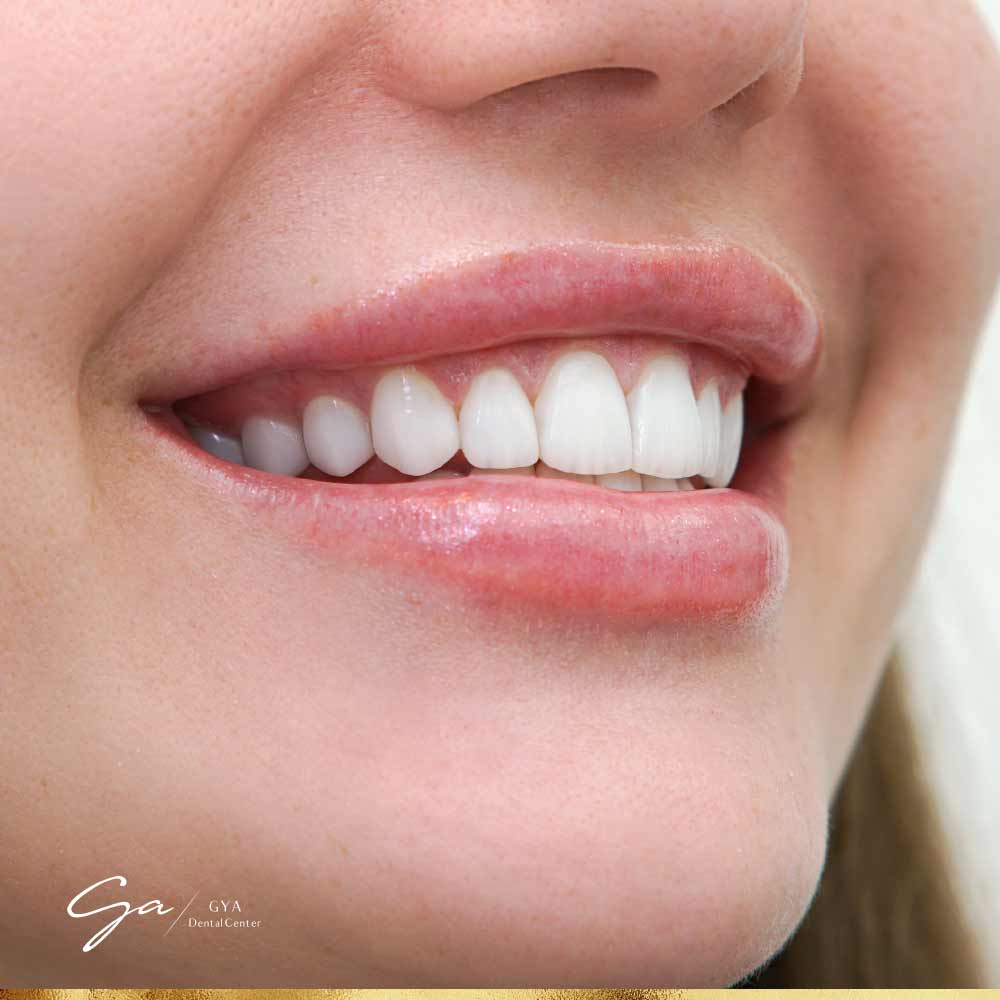 | GYA Dental Center | April, 2025 Fixing the Veneers GYA Dental Center