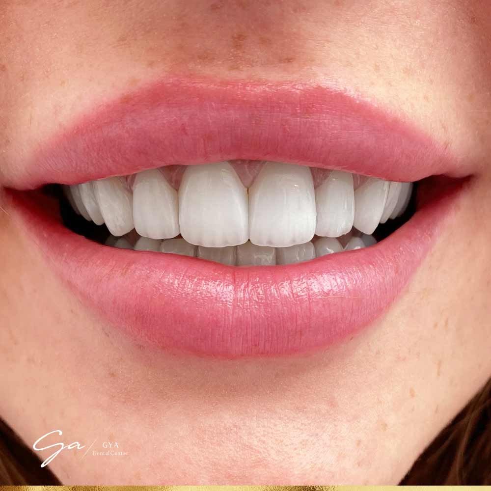 | GYA Dental Center | April, 2025 Lumineers Veneers_Best Types Of Dental Veneers In Dubai