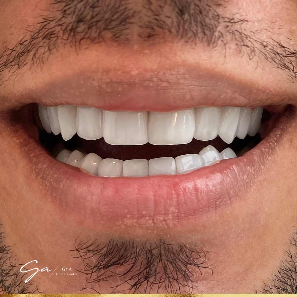 | GYA Dental Center | April, 2025 Porcelain Veneers_Best Types Of Dental Veneers In Dubai