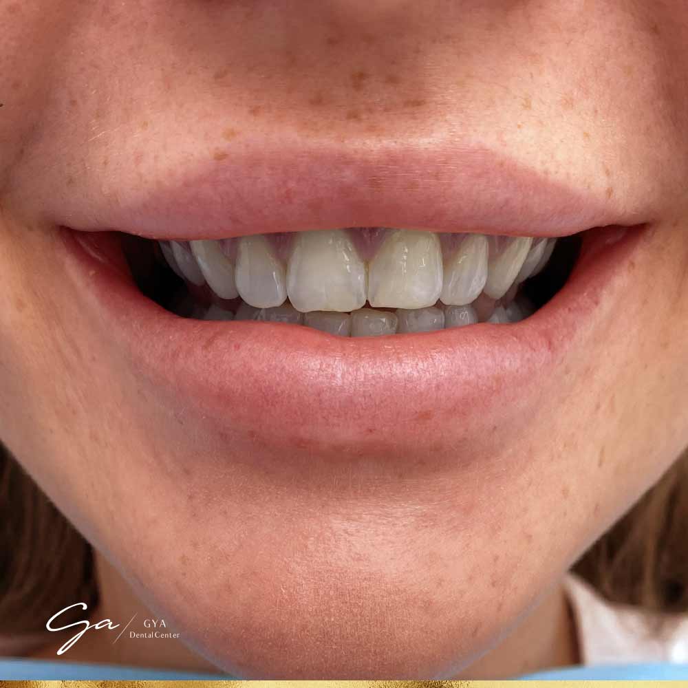 | GYA Dental Center | April, 2025 Removing a thin layer of tooth enamel GYA Dental Center