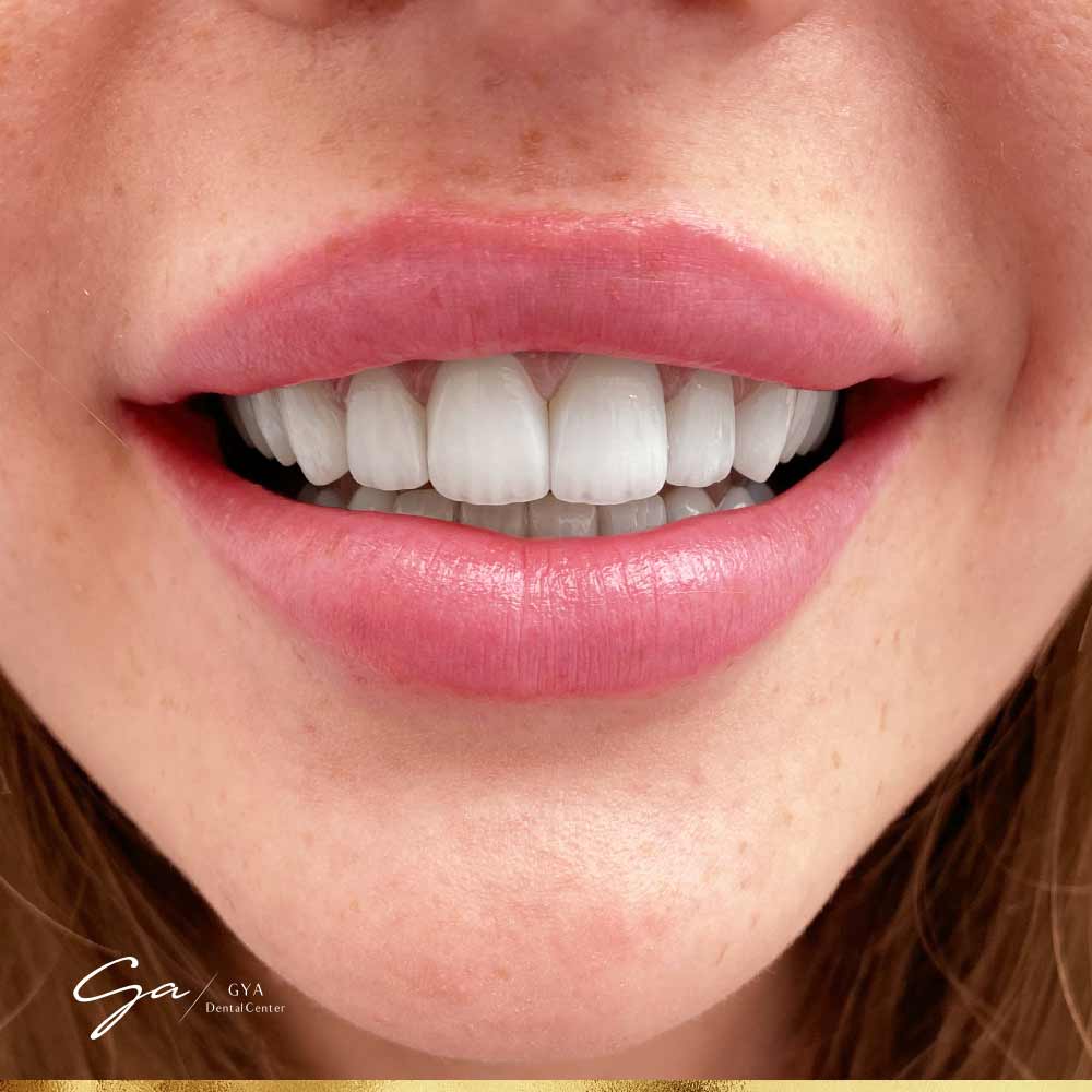 | GYA Dental Center | April, 2025 Veneer Test GYA Dental Center