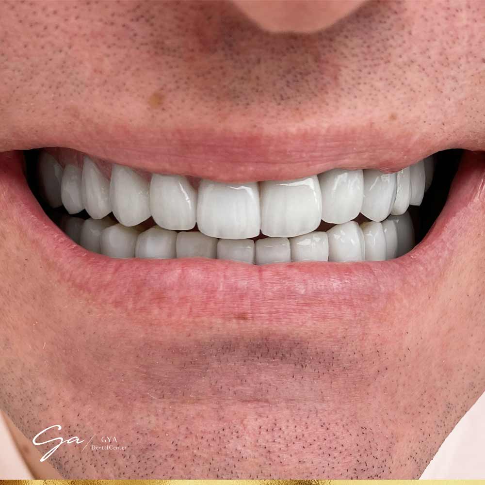 | GYA Dental Center | April, 2025 Zirconia Veneers_Best Types Of Dental Veneers In Dubai