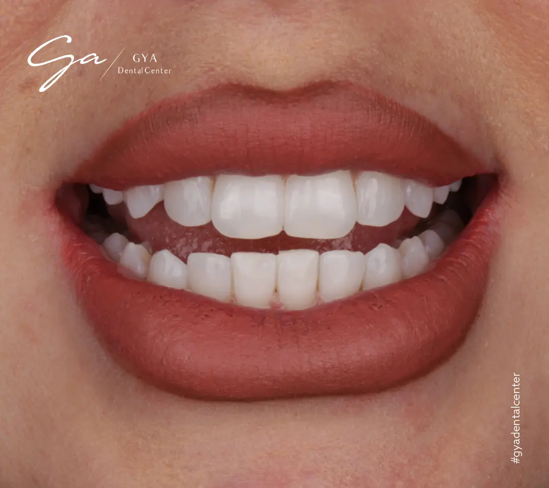 Виниры доктора Габриэллы | GYA Dental Center | Апрель, 2025