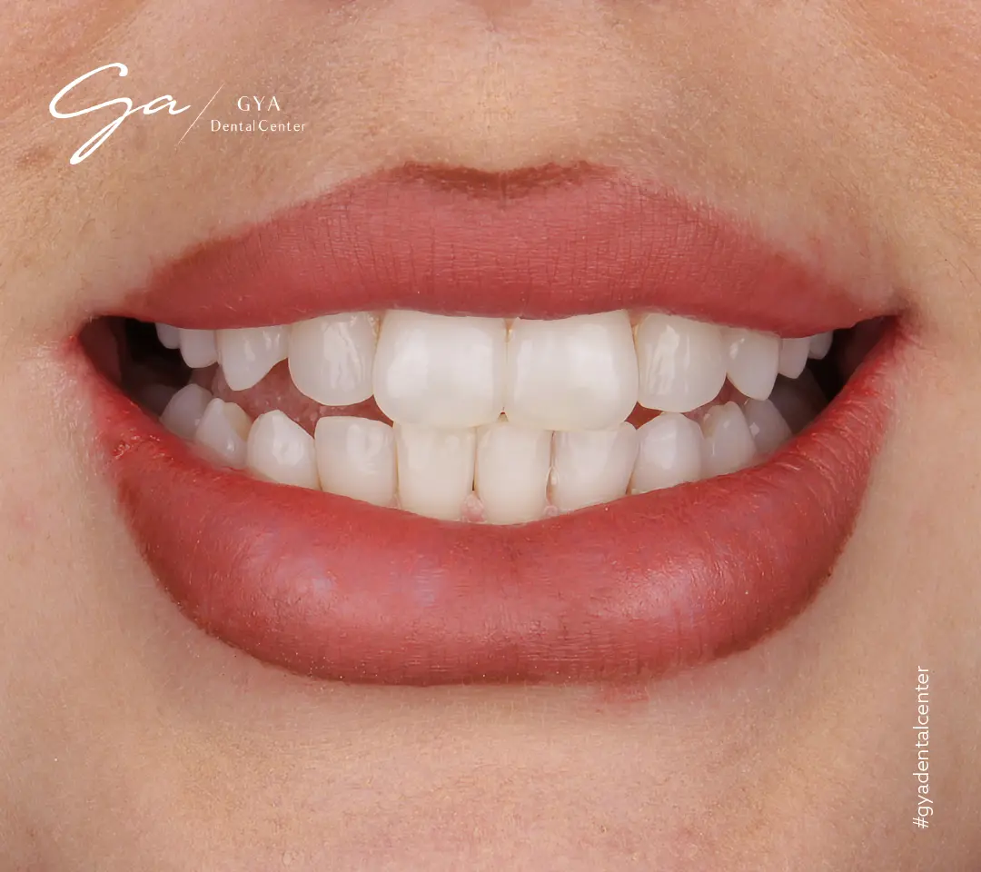 | GYA Dental Center | Апрель, 2025 | GYA Dental Center | Апрель, 2025