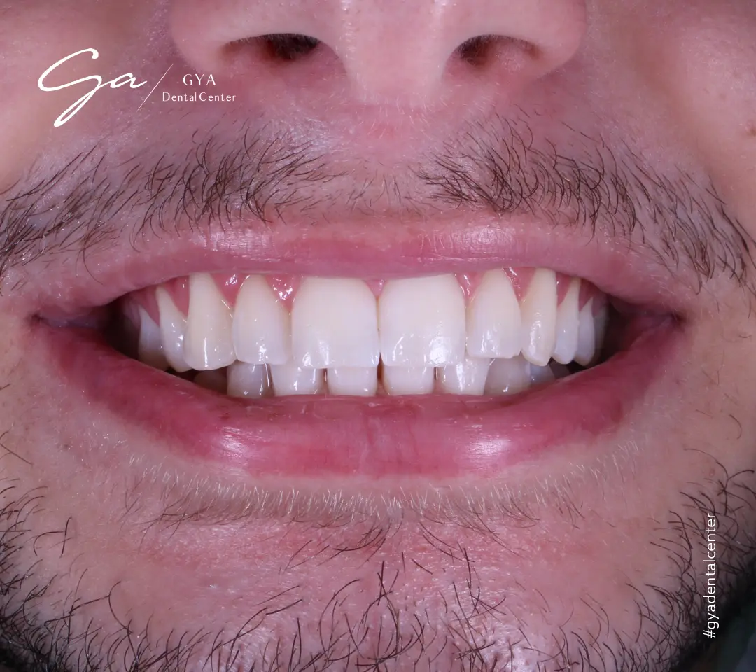 | GYA Dental Center | Апрель, 2025 | GYA Dental Center | Апрель, 2025