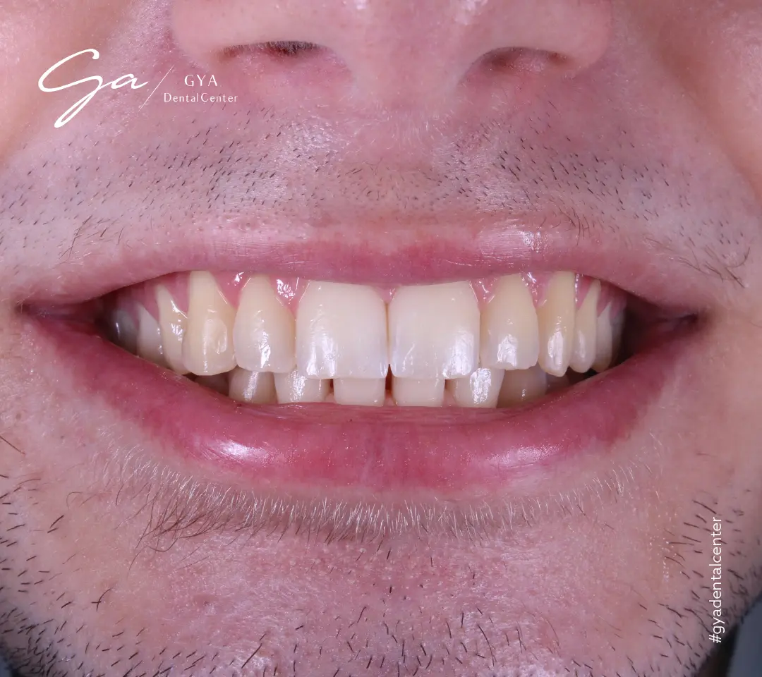 | GYA Dental Center | Апрель, 2025 | GYA Dental Center | Апрель, 2025