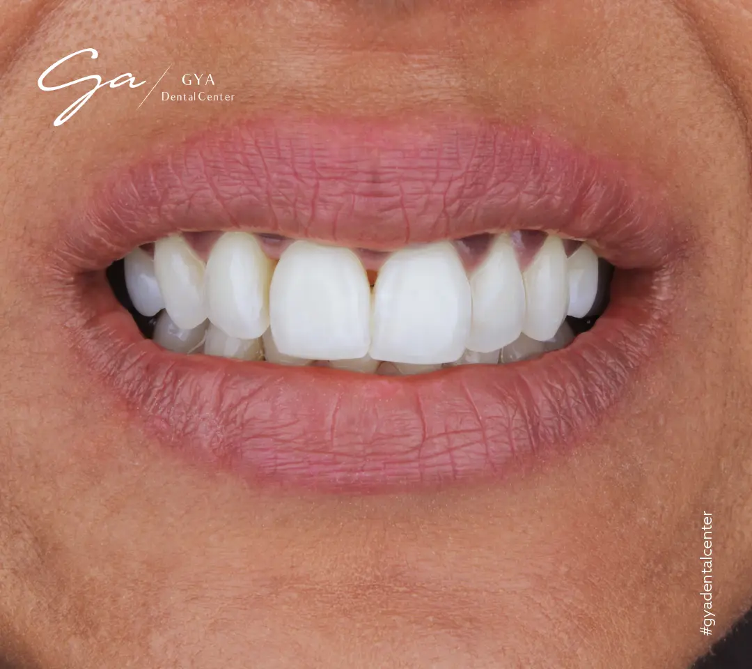 Виниры доктора Габриэллы | GYA Dental Center | Апрель, 2025